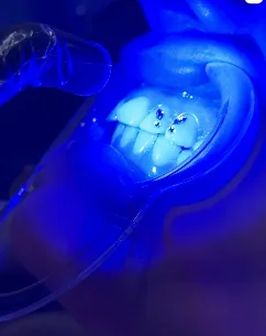 Colocación de brillantes dentales con luz UV